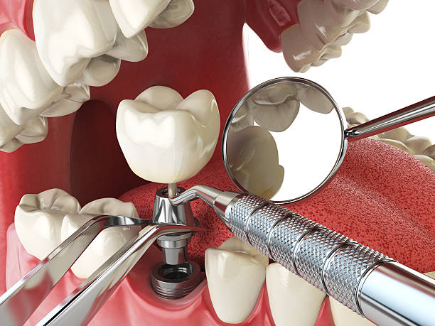Best Emergency Dental Extractions in Huntington Station, NY